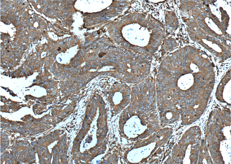 Immunohistochemistry of paraffin-embedded human colon cancer tissue slide using Catalog No:109126(CD46 Antibody) at dilution of 1:200 (under 10x lens). heat mediated antigen retrieved with Tris-EDTA buffer(pH9).