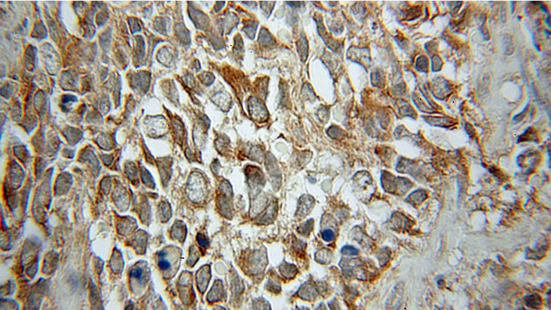 Immunohistochemical of paraffin-embedded human medulloblastoma using Catalog No:115726(STMN2 antibody) at dilution of 1:100 (under 10x lens)