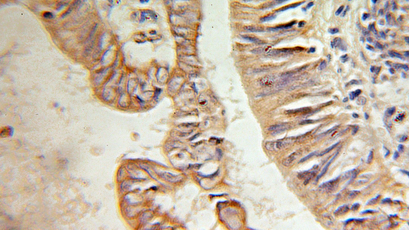 Immunohistochemical of paraffin-embedded human colon cancer using Catalog No:111452(HPS3 antibody) at dilution of 1:100 (under 10x lens)