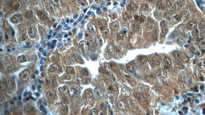 Immunohistochemistry of paraffin-embedded human lung cancer tissue slide using Catalog No:111099(GMFG Antibody) at dilution of 1:50 (under 40x lens)