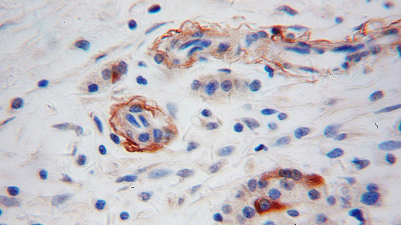 Immunohistochemical of paraffin-embedded human pancreas cancer using Catalog No:113226(NPY antibody) at dilution of 1:50 (under 40x lens)