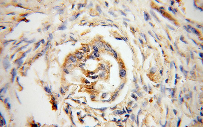Immunohistochemical of paraffin-embedded human colon cancer using Catalog No:109916(DHDH antibody) at dilution of 1:100 (under 40x lens)