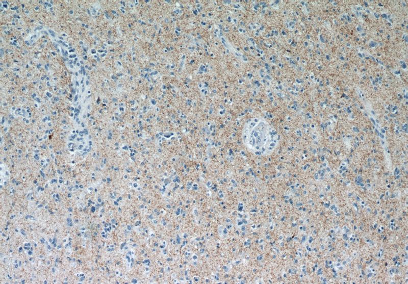 Immunohistochemistry of paraffin-embedded human gliomas tissue slide using Catalog No:115770(SYNPR Antibody) at dilution of 1:50