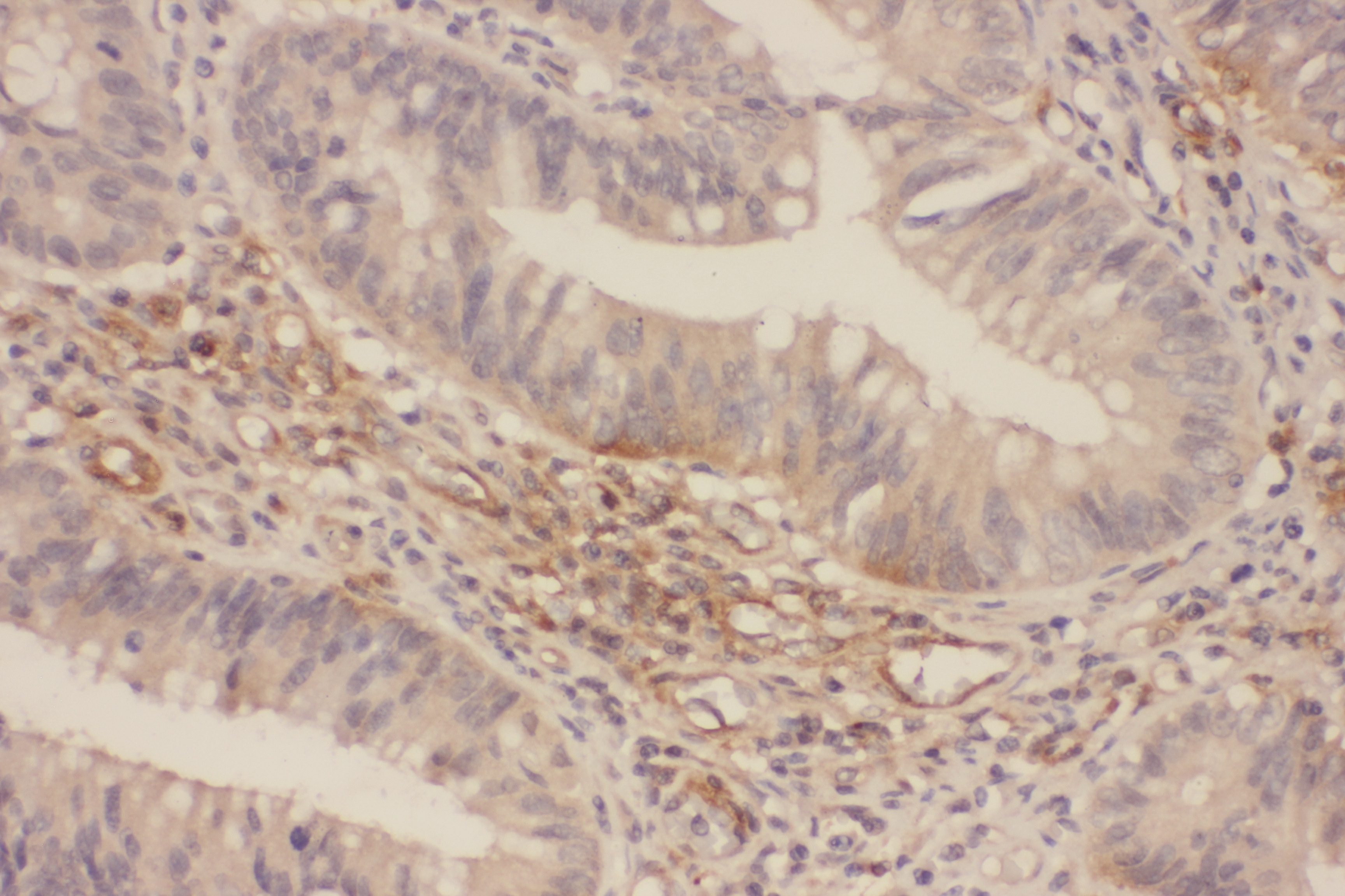 Immunohistochemical analysis of paraffin-embedded human Colorectal  tissue using p44/42 MAP Kinase (Ab-202) Antibody .