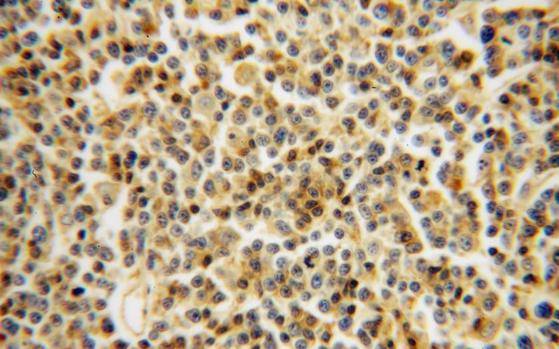 Immunohistochemical of paraffin-embedded human lymphoma using Catalog No:112172(LCK antibody) at dilution of 1:100 (under 40x lens)