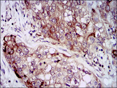 Immunohistochemical analysis of paraffin-embedded lung cancer tissues using HSP90AA1 mouse mAb with DAB staining.