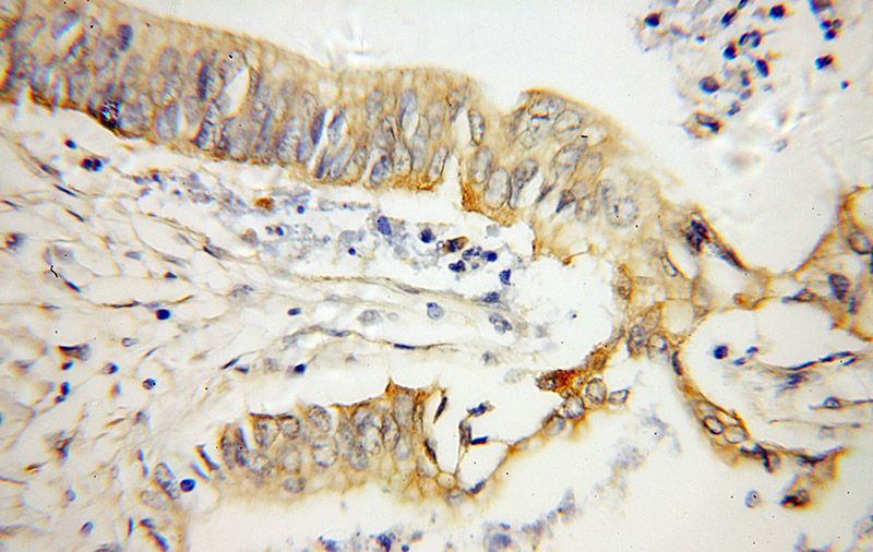 Immunohistochemical of paraffin-embedded human pancreas cancer using Catalog No:113415(OPTN antibody) at dilution of 1:50 (under 40x lens)