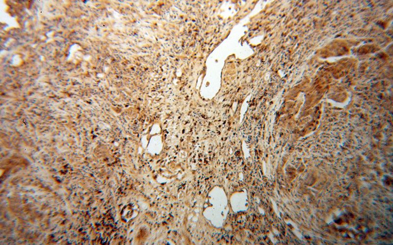 Immunohistochemical of paraffin-embedded human prostate cancer using Catalog No:113236(NR2C1 antibody) at dilution of 1:50 (under 10x lens). Heat mediated antigen retrieved with Citric acid buffer, pH6.0