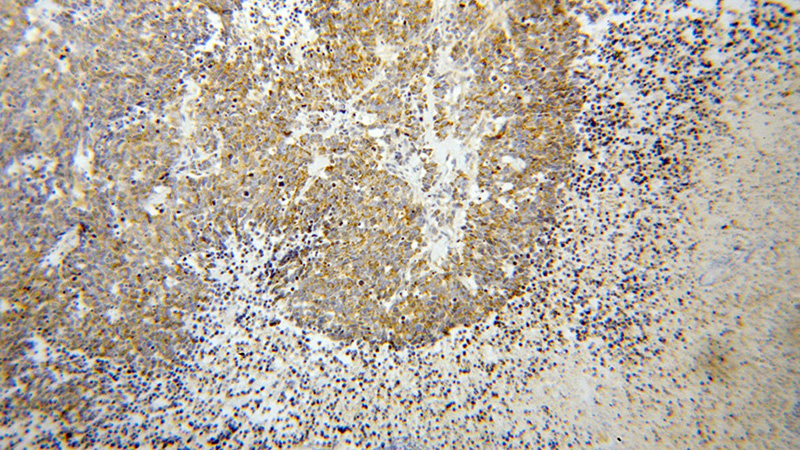 Immunohistochemical of paraffin-embedded human lung cancer using Catalog No:117258(SLC30A7 antibody) at dilution of 1:100 (under 10x lens)