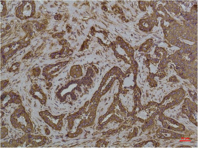 Immunohistochemical analysis of paraffin-embedded Human Breast Caricnoma using GRP78/BipMouse mAb diluted at 1:200.