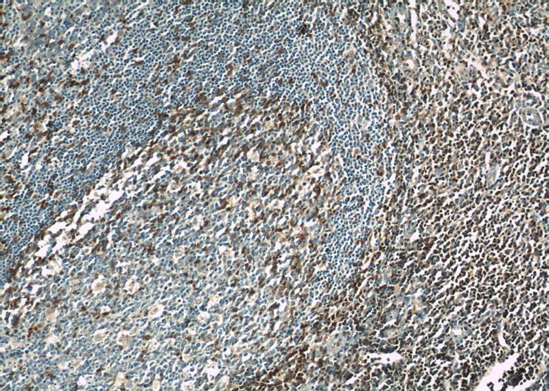 Immunohistochemical of paraffin-embedded human tonsillitis using Catalog No:115254(SKAP55,SKAP1 antibody) at dilution of 1:50 (under 10x lens)