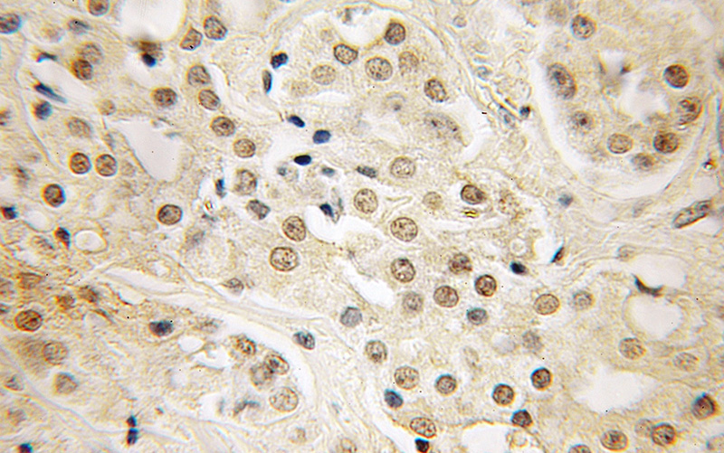 Immunohistochemical of paraffin-embedded human prostate cancer using Catalog No:112231(LIN28 antibody) at dilution of 1:50 (under 40x lens)