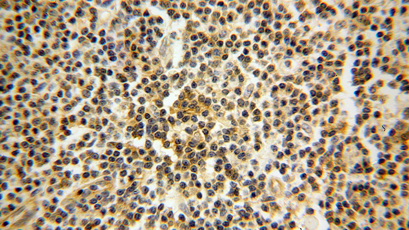Immunohistochemical of paraffin-embedded human lymphoma using Catalog No:111622(IFITM1 antibody) at dilution of 1:50 (under 40x lens)