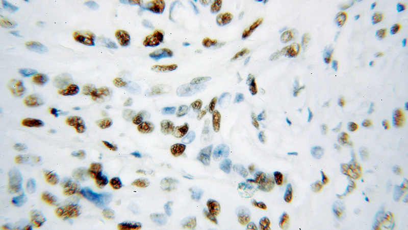 Immunohistochemical of paraffin-embedded human colon cancer using Catalog No:111911(KAP1 antibody) at dilution of 1:100 (under 40x lens)