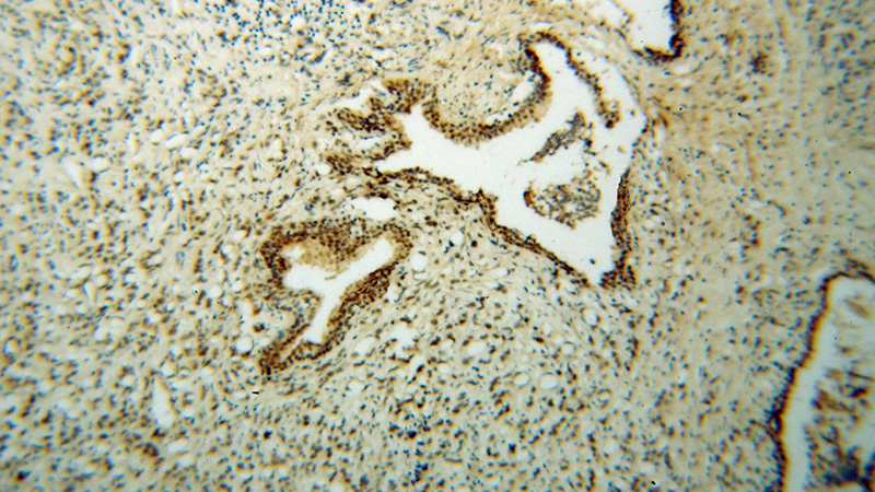 Immunohistochemical of paraffin-embedded human prostate cancer using Catalog No:114710(RING1 antibody) at dilution of 1:50 (under 10x lens)