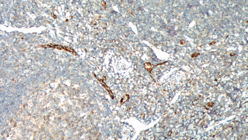 Immunohistochemistry of paraffin-embedded human tonsillitis tissue slide using Catalog No:116811(VWF, VWFpp Antibody) at dilution of 1:200 (under 10x lens).