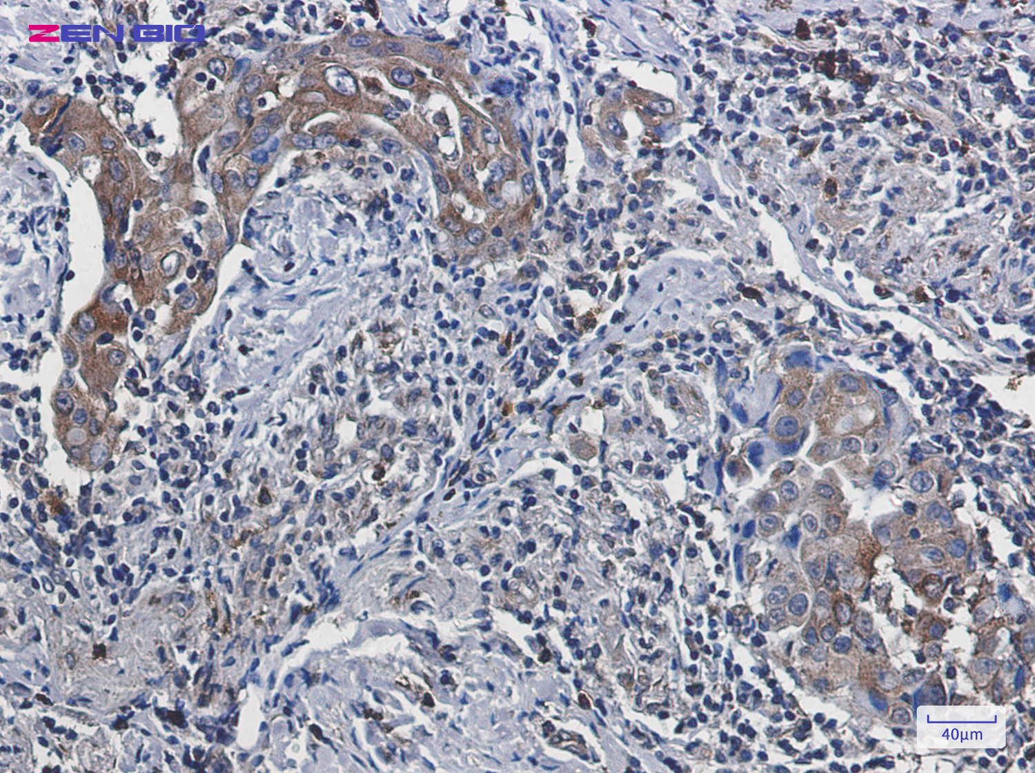 Immunohistochemistry of FACL4 in paraffin-embedded Human lung cancer tissue using FACL4 Rabbit pAb at dilution 1/50