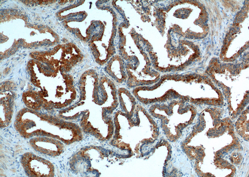 Immunohistochemistry of paraffin-embedded human prostate hyperplasia tissue slide using Catalog No:108404(BAD Antibody) at dilution of 1:200 (under 10x lens)