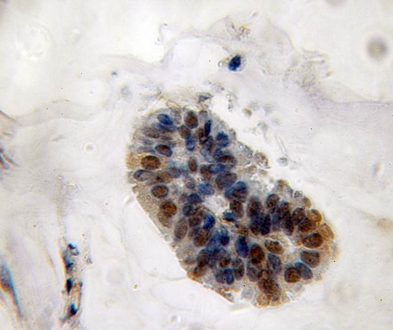 Immunohistochemical of paraffin-embedded human breast cancer using Catalog No:112743(MPHOSPH6 antibody) at dilution of 1:50 (under 10x lens)