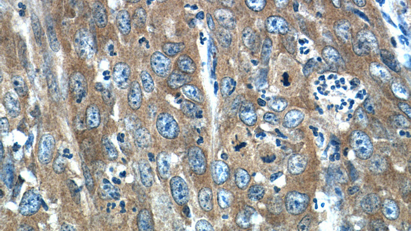 Immunohistochemistry of paraffin-embedded human cervical cancer tissue slide using Catalog No:112696(MMP1 Antibody) at dilution of 1:200 (under 40x lens)