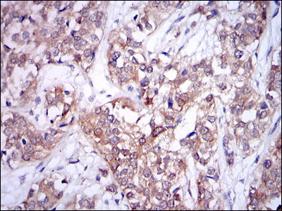 Immunohistochemical analysis of paraffin-embedded bladder cancer tissues using UBE2I mouse mAb with DAB staining.