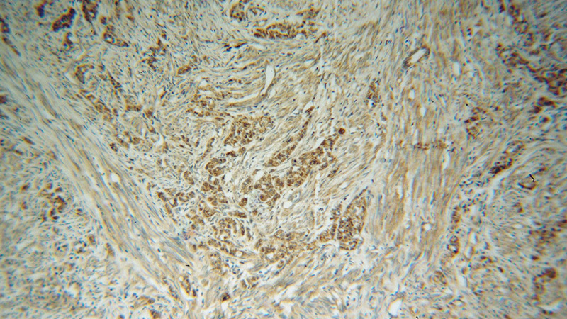 Immunohistochemical of paraffin-embedded human endometrial cancer using Catalog No:112192(LEFTY2 antibody) at dilution of 1:50 (under 10x lens)
