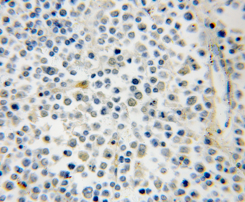 Immunohistochemical of paraffin-embedded human lymphoma using Catalog No:114438(RAB39B antibody) at dilution of 1:50 (under 10x lens)