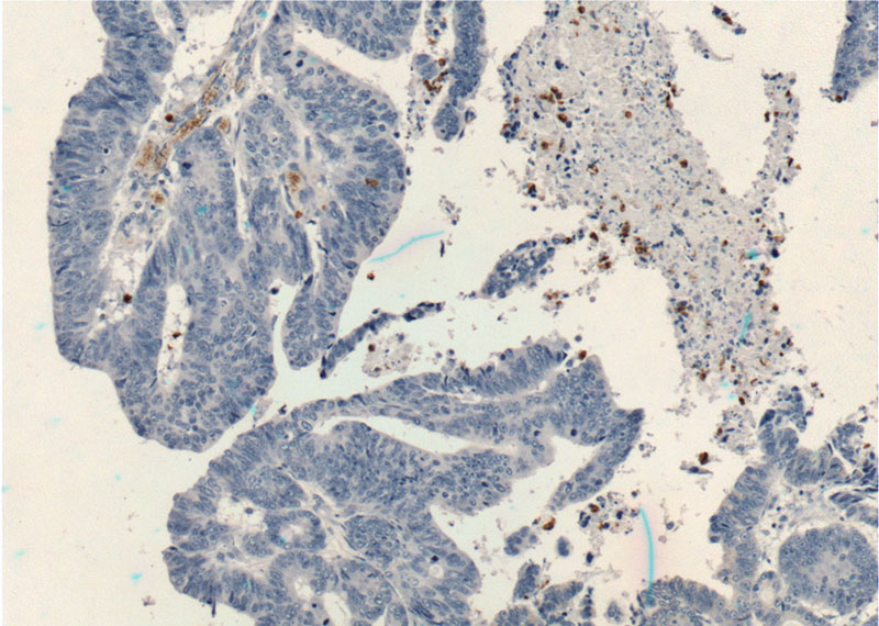 Immunohistochemistry of paraffin-embedded human colon cancer tissue slide using Catalog No:115950(TESC Antibody) at dilution of 1:200 (under 10x lens).