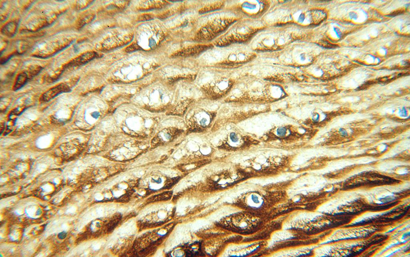 Immunohistochemical of paraffin-embedded human cervix using Catalog No:112134(KRT6B antibody) at dilution of 1:100 (under 40x lens)