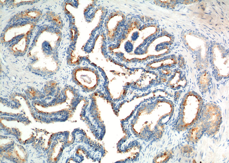 Immunohistochemistry of paraffin-embedded human prostate hyperplasia tissue slide using Catalog No:111131(GPR55 Antibody) at dilution of 1:200 (under 10x lens).