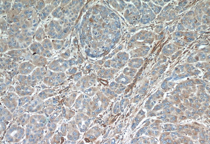Immunohistochemical of paraffin-embedded human liver cancer using Catalog No:108094(ANXA3 antibody) at dilution of 1:50 (under 10x lens)