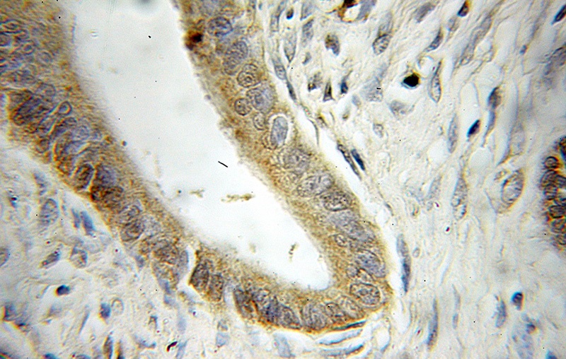 Immunohistochemical of paraffin-embedded human pancreas cancer using Catalog No:116845(WBP1 antibody) at dilution of 1:50 (under 10x lens)