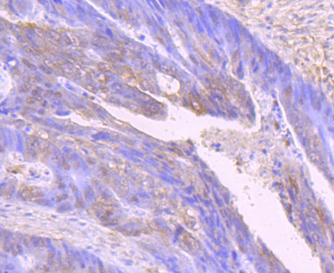 Fig7: Immunohistochemical analysis of paraffin-embedded human colon cancer tissue using anti-IL7 antibody. Counter stained with hematoxylin.
