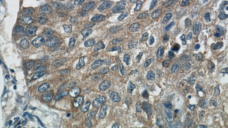 Immunohistochemistry of paraffin-embedded human lung cancer tissue slide using Catalog No:110962(GGT7 Antibody) at dilution of 1:50