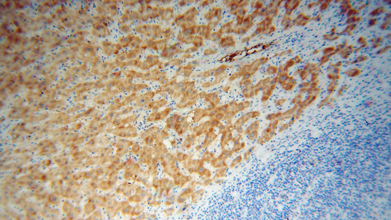 Immunohistochemical of paraffin-embedded human liver cancer using Catalog No:111467(UK114; HRSP12 antibody) at dilution of 1:100 (under 10x lens)