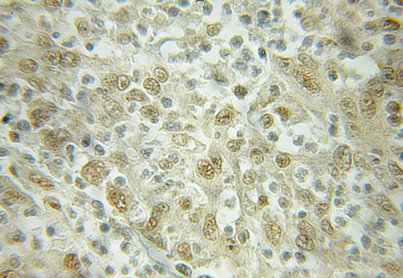 Immunohistochemical of paraffin-embedded human colon cancer using Catalog No:111787(KPNB1 antibody) at dilution of 1:50 (under 10x lens)