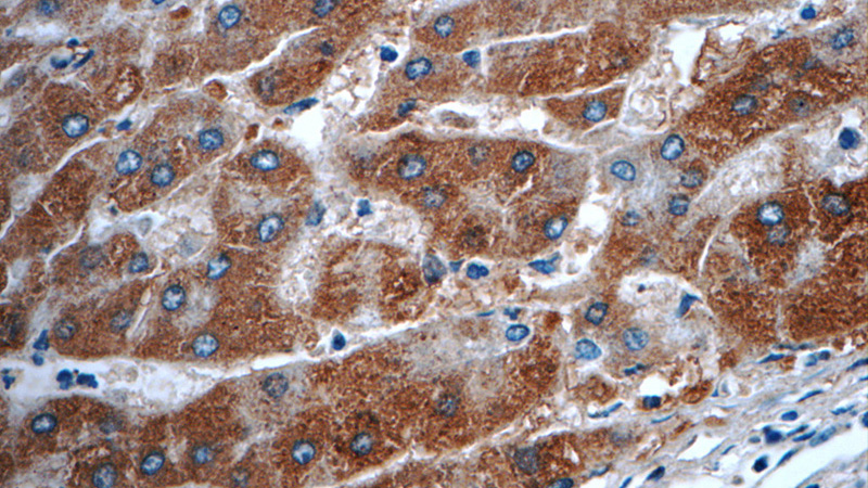 Immunohistochemistry of paraffin-embedded human hepatocirrhosis tissue slide using Catalog No:110668(FJX1 Antibody) at dilution of 1:50 (under 40x lens)