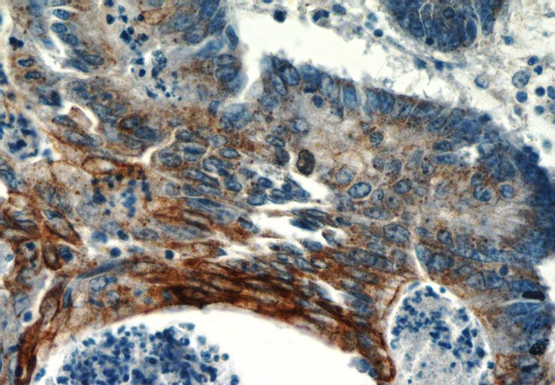 Immunohistochemistry of paraffin-embedded human colon cancer slide using Catalog No:116201(TMEM9B Antibody) at dilution of 1:50