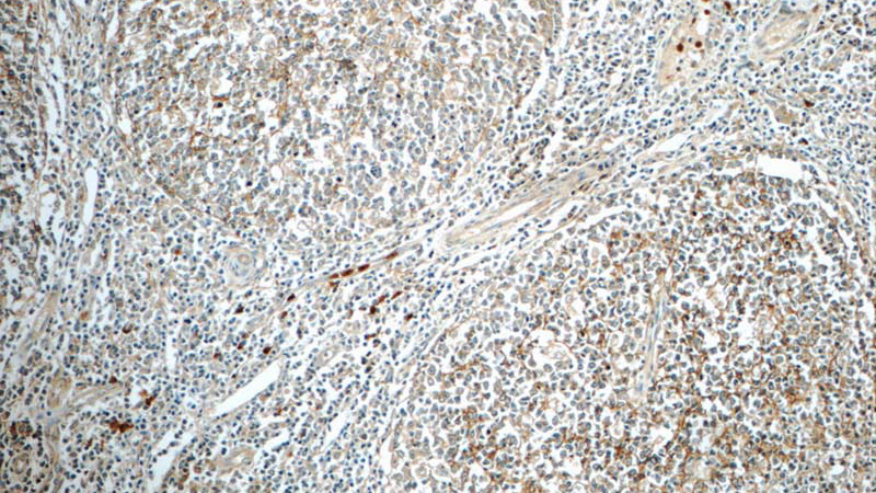 Immunohistochemistry of paraffin-embedded human tonsillitis tissue slide using Catalog No:109042(CD11B Antibody) at dilution of 1:50 (under 10x lens)