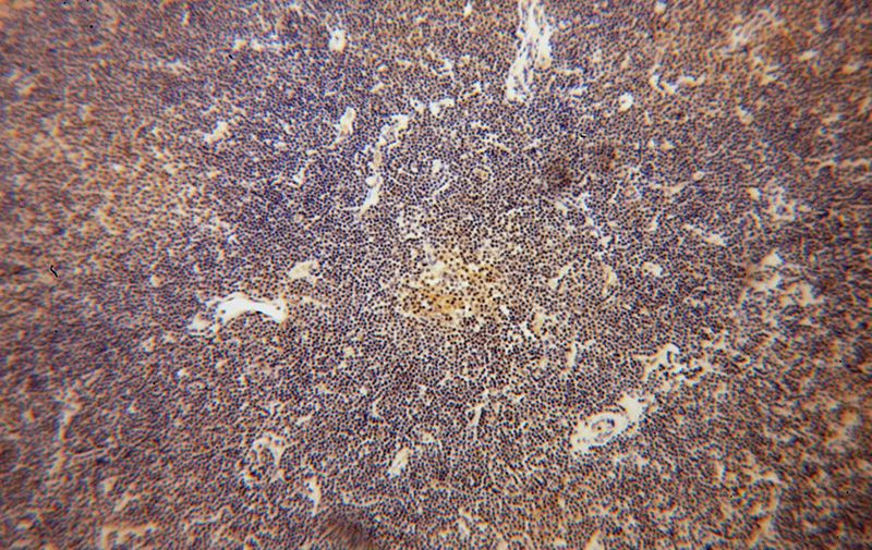 Immunohistochemical of paraffin-embedded human lymphoma using Catalog No:111952(ITM2A antibody) at dilution of 1:50 (under 10x lens)