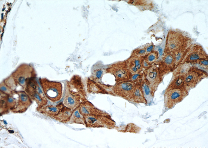 Immunohistochemical of paraffin-embedded human breast cancer using Catalog No:113309(NOTCH3 antibody) at dilution of 1:50 (under 40x lens)