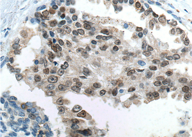 Immunohistochemistry of paraffin-embedded human prostate cancer tissue slide using Catalog No:110745(FOXA1 Antibody) at dilution of 1:200 (under 40x lens). heat mediated antigen retrieved with Tris-EDTA buffer(pH9).