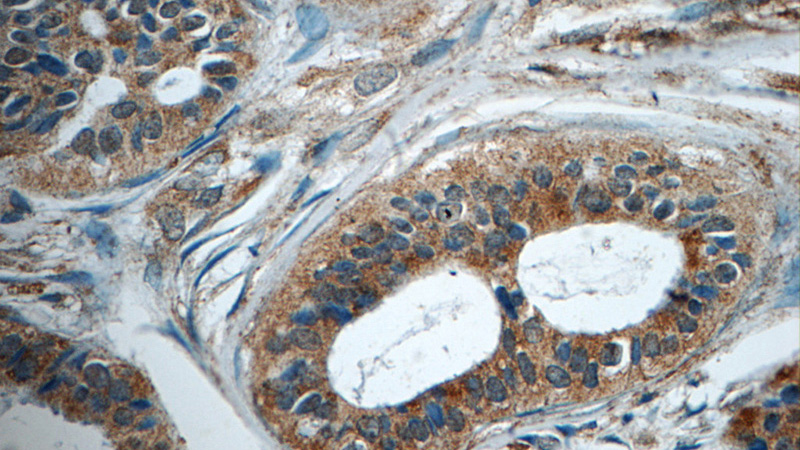 Immunohistochemistry of paraffin-embedded human breast cancer tissue slide using Catalog No:115055(SAMD9L Antibody) at dilution of 1:50 (under 40x lens)