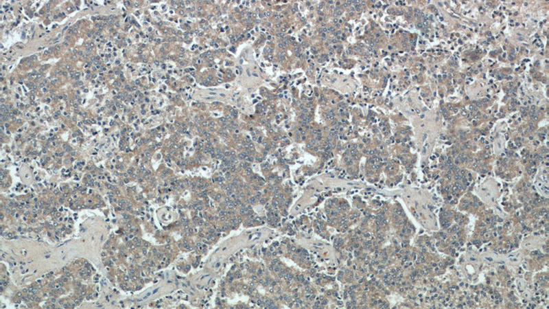 Immunohistochemical of paraffin-embedded human prostate cancer using Catalog No:111168(GSK3A antibody) at dilution of 1:50 (under 10x lens)