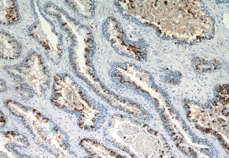 Immunohistochemical of paraffin-embedded human prostate hyperplasia using Catalog No:113928(PLA2G4F antibody) at dilution of 1:200 (under 10x lens)