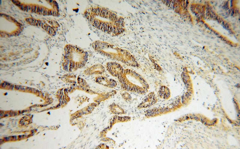 Immunohistochemical of paraffin-embedded human colon cancer using Catalog No:109543(CKB antibody) at dilution of 1:100 (under 10x lens)