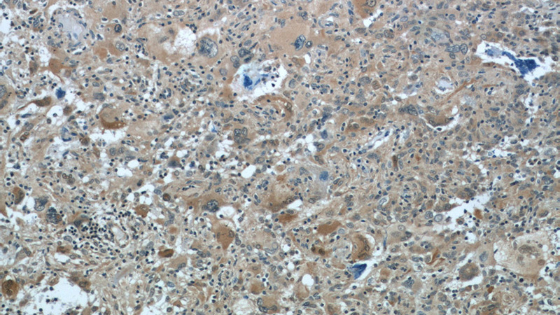 Immunohistochemistry of paraffin-embedded human gliomas tissue slide using Catalog No:112389(MAGED1 Antibody) at dilution of 1:100 (under 10x lens)