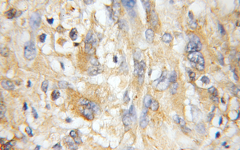 Immunohistochemical of paraffin-embedded human gliomas using Catalog No:113255(NMT1 antibody) at dilution of 1:50 (under 10x lens)