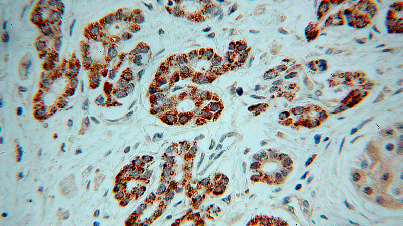 Immunohistochemical of paraffin-embedded human pancreas cancer using Catalog No:113192(NIT1 antibody) at dilution of 1:50 (under 40x lens)