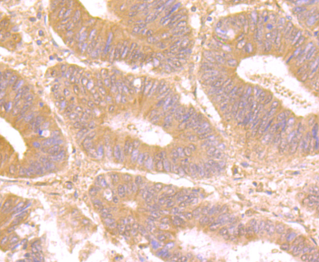 Fig6:; Immunohistochemical analysis of paraffin-embedded human colon carcinoma tissue using anti-Galectin 8 antibody. The section was pre-treated using heat mediated antigen retrieval with Tris-EDTA buffer (pH 8.0-8.4) for 20 minutes.The tissues were blocked in 5% BSA for 30 minutes at room temperature, washed with ddH; 2; O and PBS, and then probed with the primary antibody ( 1/50) for 30 minutes at room temperature. The detection was performed using an HRP conjugated compact polymer system. DAB was used as the chromogen. Tissues were counterstained with hematoxylin and mounted with DPX.